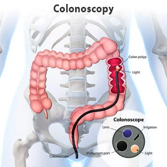 colonoscopy-s1-what-is-colonoscopy-illustration