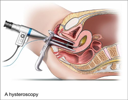 gynaecological-endoscopy-500x500